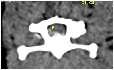 Case report: Double adjacent ventral slot in two medium-sized breed dogs